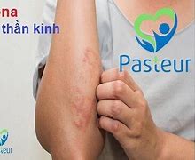 Nhiễm Trùng Thần Kinh Là Gì